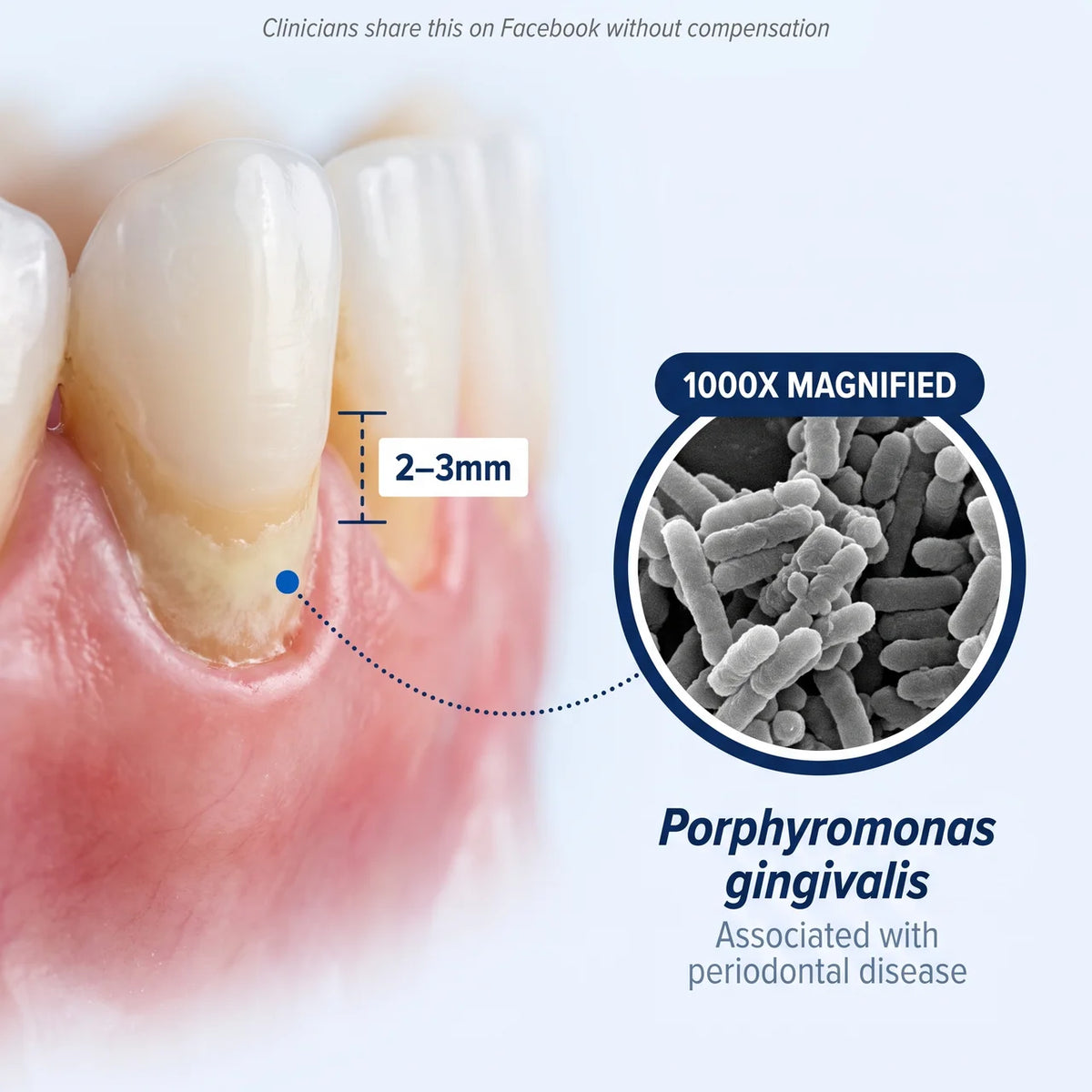Gum recession